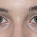 Носослезная борозда