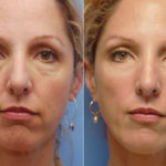 Грыжа верхнего и нижнего века