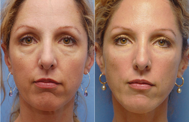 Грыжа верхнего и нижнего века