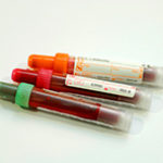 Новый тест для диагностики рака лучше биопсии, говорят ученые