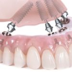 Почему несъемное протезирование пользуется популярностью?