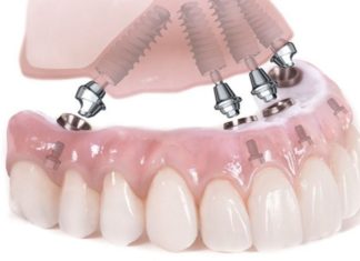 Почему несъемное протезирование пользуется популярностью?