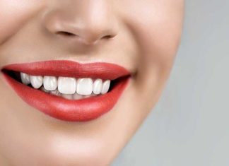 Как устанавливают зубные виниры?