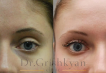 Блефаропластика: несколько фактов о процедуре