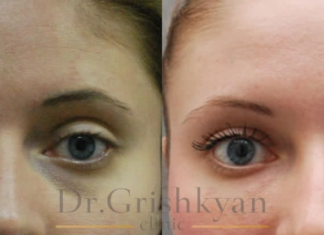 Блефаропластика: несколько фактов о процедуре