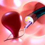 Удаление полипов шейки матки: как осуществляется процедура