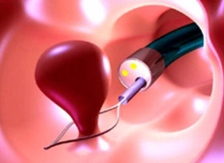 Удаление полипов шейки матки: как осуществляется процедура