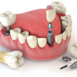 Зубное протезирование: какие бывают виды