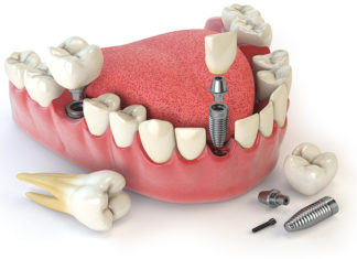 Зубное протезирование: какие бывают виды