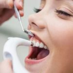 Профессиональная чистка зубов: как часто проводить