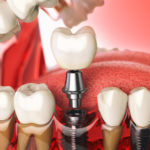 Имплантация зубов: во сколько этапов проходит