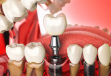Имплантация зубов: особенности прохождения этапов