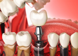 Имплантация зубов: особенности прохождения этапов