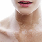 Витилиго: выбираем средства для лечения