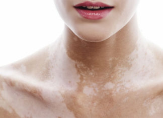 Витилиго: выбираем средства для лечения