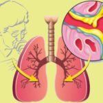 Как бороться с мокротой: советы