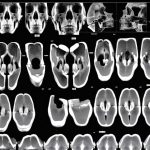 Челюстно-лицевая томография: особенности проведения