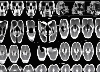 Челюстно-лицевая томография: особенности проведения