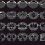 КТ околоносовых пазух: современный метод диагностики