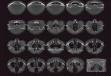 КТ околоносовых пазух: современный метод диагностики