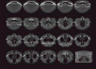 КТ околоносовых пазух: современный метод диагностики