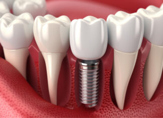 Имплантация зубов «под ключ»: преимущества и этапы процедуры