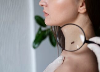 Избавление от бородавок: древний заговор