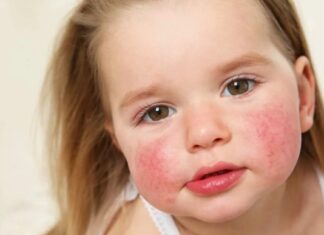 Простуда или аллергия у ребенка? Ваша шпаргалка для спокойствия